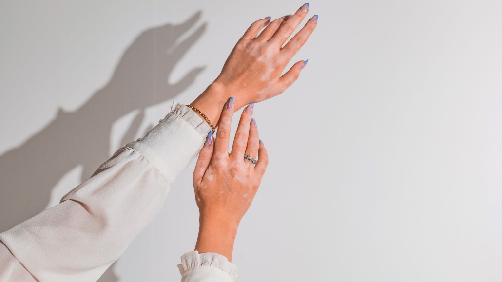 Depilación láser en pieles con dermatitis 