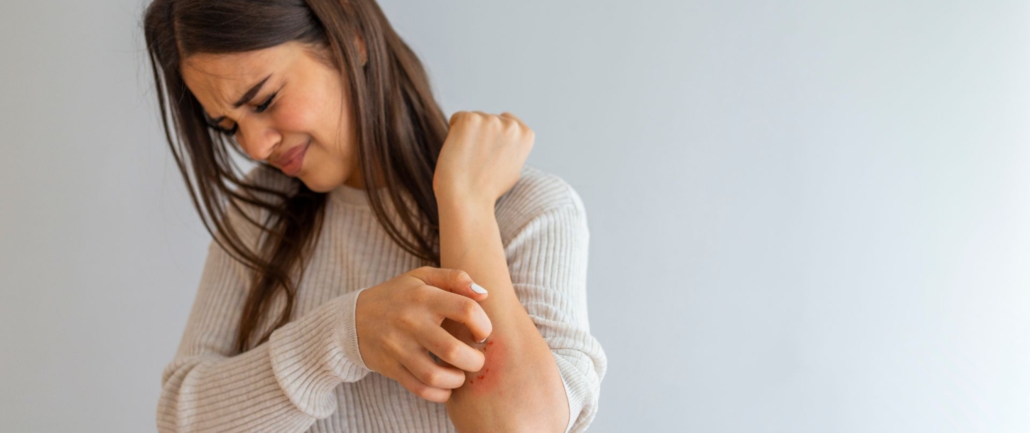 Irritación en piel por dermatitis 