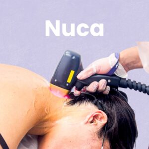 Depilación láser Nuca
